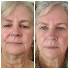 Susan before and after using TECA Skin Repair Cream